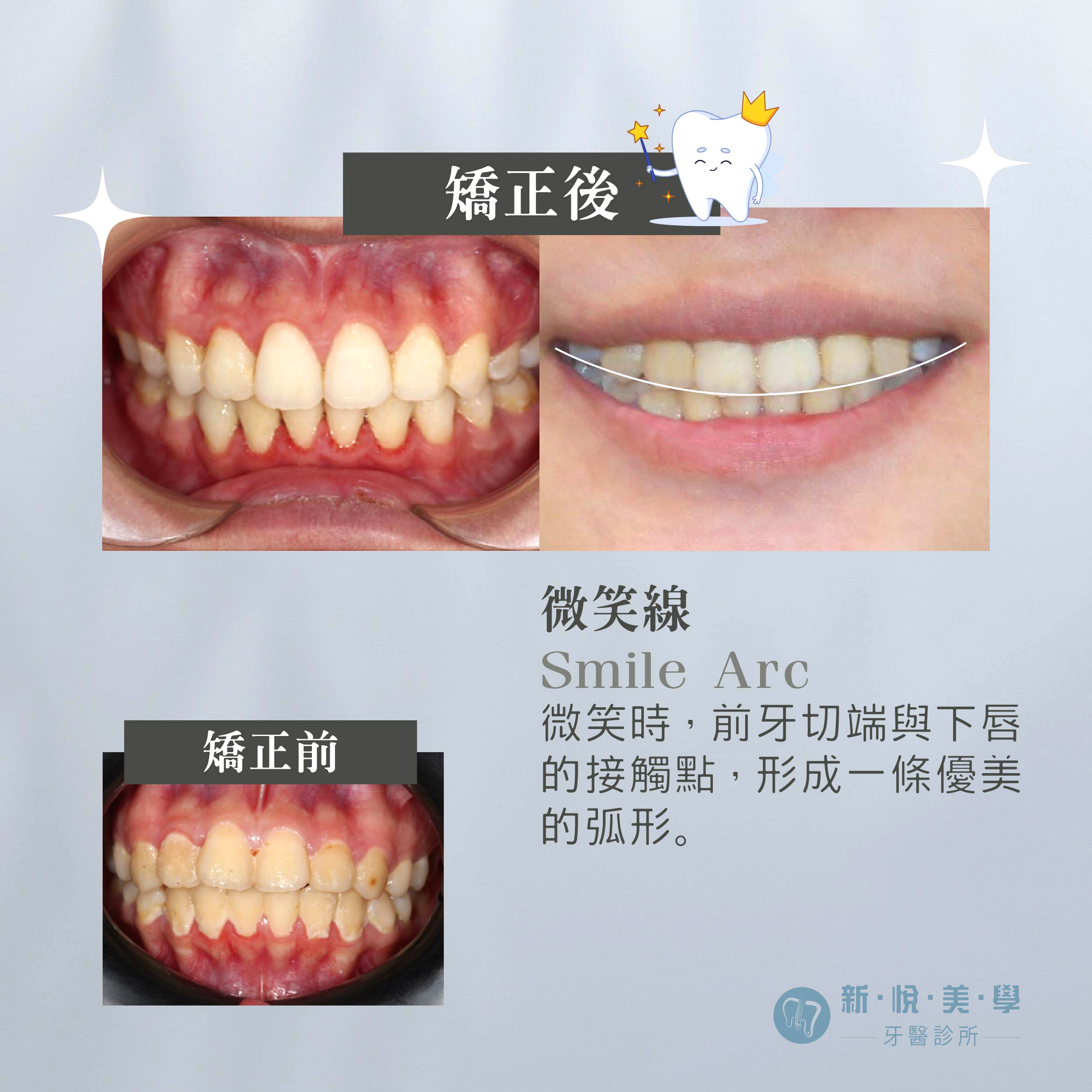 [新悅美學牙醫案例] 趁早開始，就醫定會改變的第2張圖片